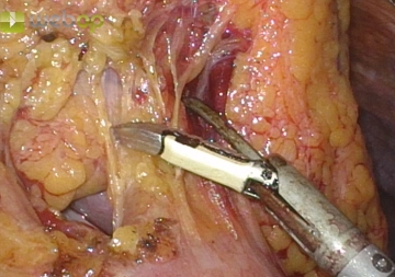 Detachment of the greater omentum