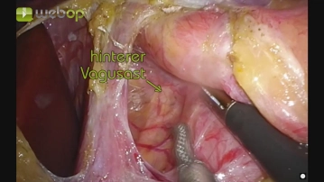 Dissection of the Diaphragmatic Crura with Exposure of the Distal Esophagus