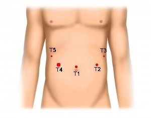 Trocar Positioning