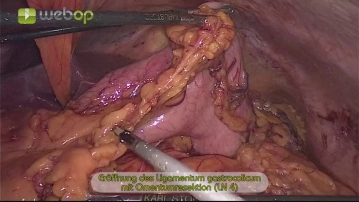 Incision of the gastrocolic ligament with omentum resection (LN 4)