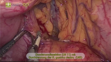 Dissection of the Duodenum (LN 11) and Transection of the Right Gastric Artery