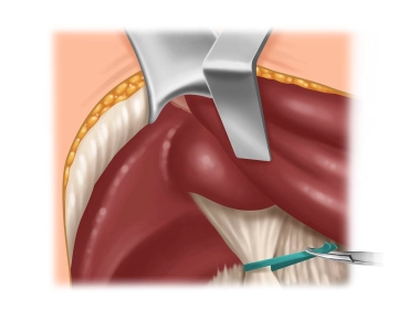 Liver Hilum Preparation