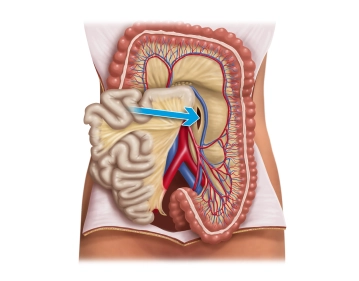 Preparation on the Gerota's fascia from medial and transection of the inferior mesenteric vein