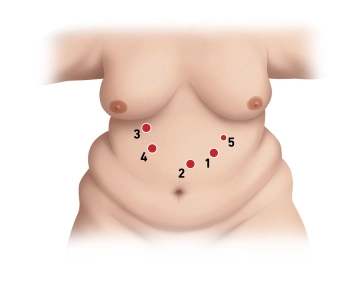 Optical Access; Trocar Placement