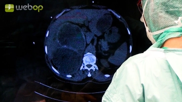 Findings collection; Adhesiolysis; Preparation of the extrahepatic pericyst in the left liver lobe