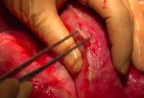 Inspection and Adhesiolysis