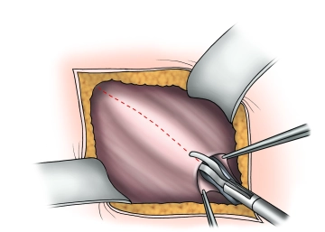 Splitting of the external aponeurosis