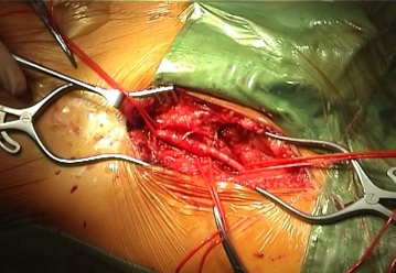 Exposing the right groin and femoral bifurcation