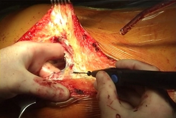 Laparotomy