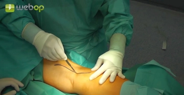 Posterior approach to the right popliteal artery