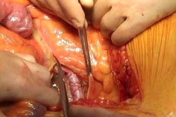 Opening the retroperitoneum and exposing the left renal vein