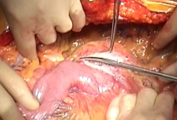 3. Opening the retroperitoneum