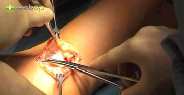 Access in the right cubital fossa