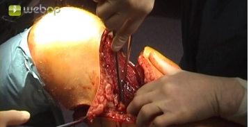 Locating and identifying the femoral vessels