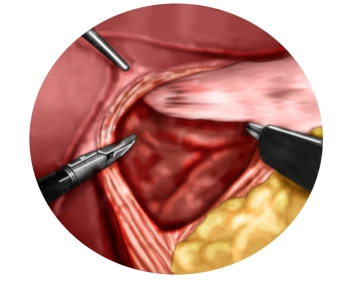 Preparation of the diaphragmatic crura with entry into the mediastinum