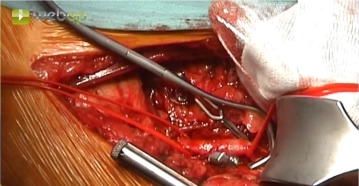 Suprageniculate exposure of the popliteal artery, segment P1