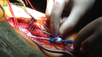 Puncture of the common femoral artery after exposure of the left groin