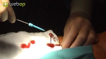 Puncture of the right common femoral artery