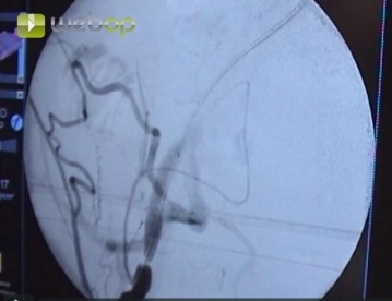 Crossing the stenoses with a Terumo® wire