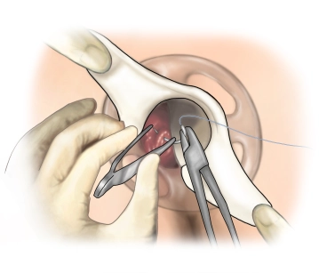 Purse-string suture