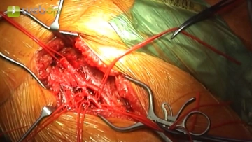 Preparation of the femoral bifurcation