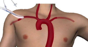 Right infraclavicular access, suturing in of a conduit, probing of the aorta