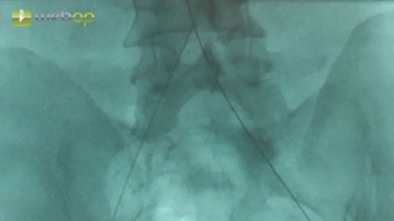Bilateral transfemoral accesses, aortic probing