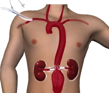 Probing of the Renal Arteries