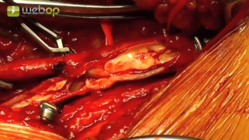 Clamping of the femoral bifurcation and arteriotomy