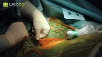 Puncture of the right internal jugular vein