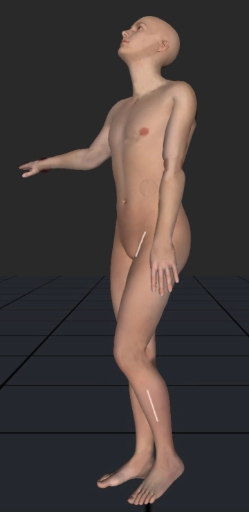 Accesso laterale all'arteria tibialis anterior sinistra