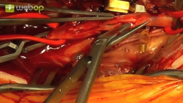Incisione dell'arteria tibialis anterior