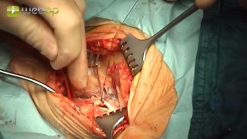 Ligation of the facial vein, partial transection of the digastric muscle