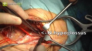 Preparation of the ACE and ACI, Mobilization of the Hypoglossal Nerve