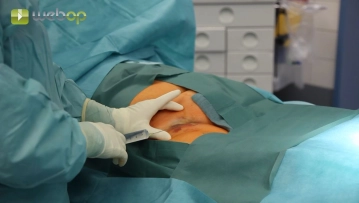 Puncture of the right common femoral artery