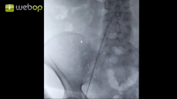 Advancing the sheath up to the aortic arch