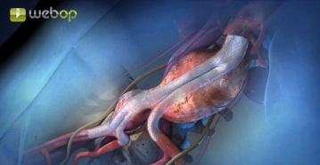 Principle of the Endovascular Procedure