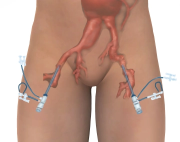 Bilateral inguinal access