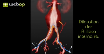Crossover catheterisation of the right common iliac artery, dilatation of the right internal iliac artery origin