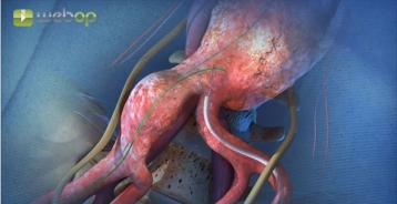 Insertion and prepositioning of the iliac branch component