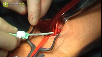Puncture of the left brachial artery using Seldinger technique