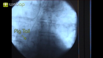 Placement of a pigtail catheter