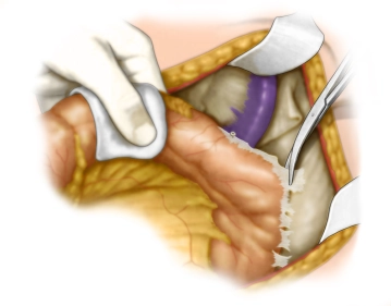 Mobilization of the left colon