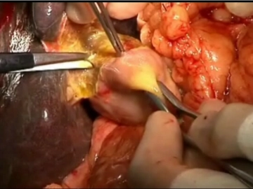 Cholecystectomy