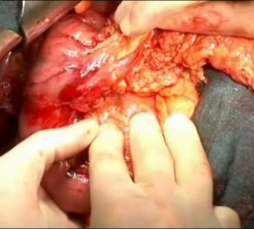 Palpation of the Pancreatic Head