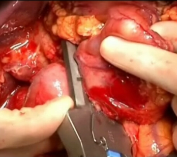 Transection of the Postpyloric Duodenum