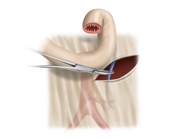 Management of the Inferior Mesenteric Vein