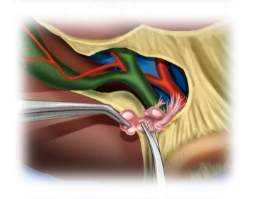 Visualization of the Ligamentum hepatoduodenale with complete extrahepatic lymphadenectomy