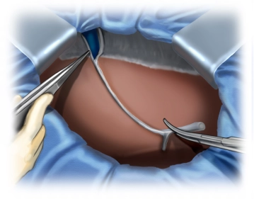 Transection of the falciform ligament of the liver