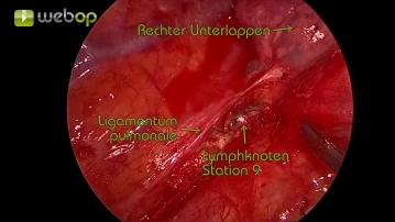 Exploration of the thorax and preparation of the pulmonary ligament